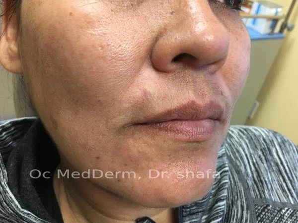 After Mole Removal on Face in irvine, CA