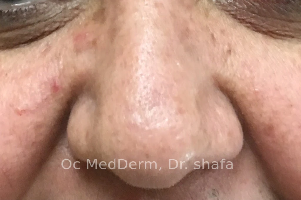 After Mole Removal on Nose In Irvine, CA