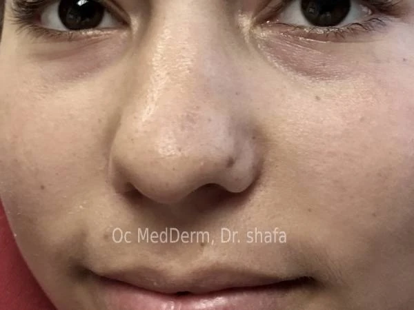 After Mole Removal on Nose at OC MedDerm