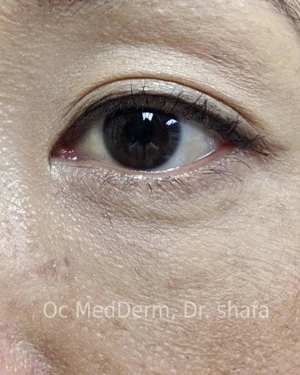 After Mole Removal under Eye In Irvine, CA