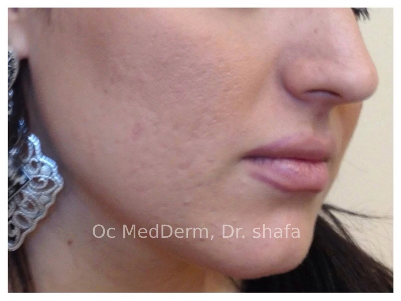 After Salicylic Acid Peel Treatment in Irvine, CA