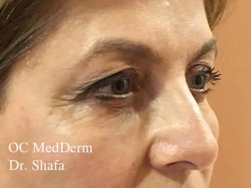 Before CO2 Laser Resurfcing For Wrinkles in Irvine, CA