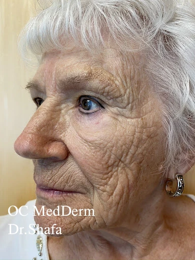 Before Deep skin rejuvenation by CO2 laser in Irvine, CA at OC MedDerm