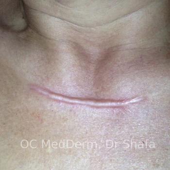 Before Keloid Treatment with steroid injection in Irvine, CA