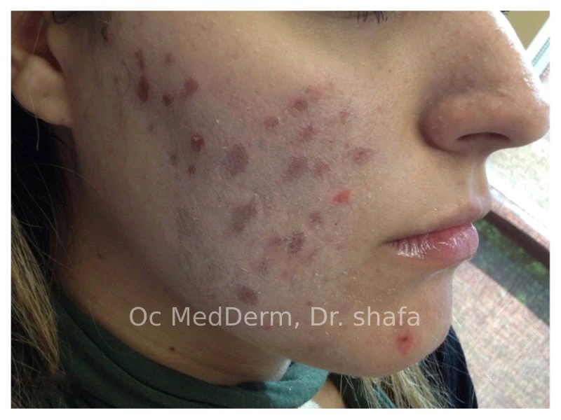Before Salicylic Acid Peel Treatment in Irvine, CA