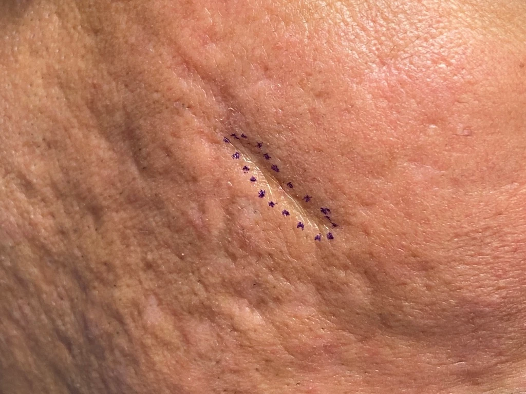 Before scar removal by excision in Irvine, CA