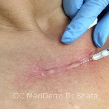 During Keloid Treatment with Steroid Injection in Irvine, CA