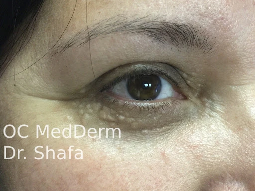 Eye Syringoma Removal Irvine, Orange County, CA