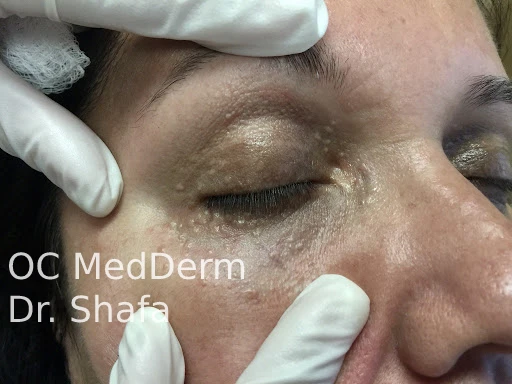 How Syringomas treated in Irvine, CA at OC MedDerm