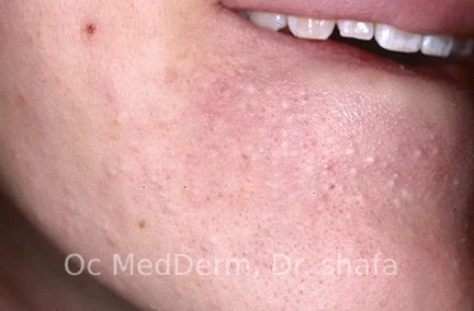Mild Acne Irvineskin