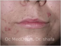 Moderate Acne - OC MedDerm