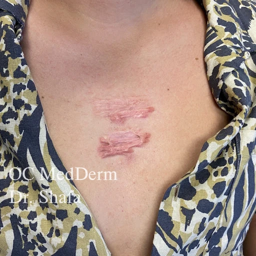 Locations prone to keloid formation