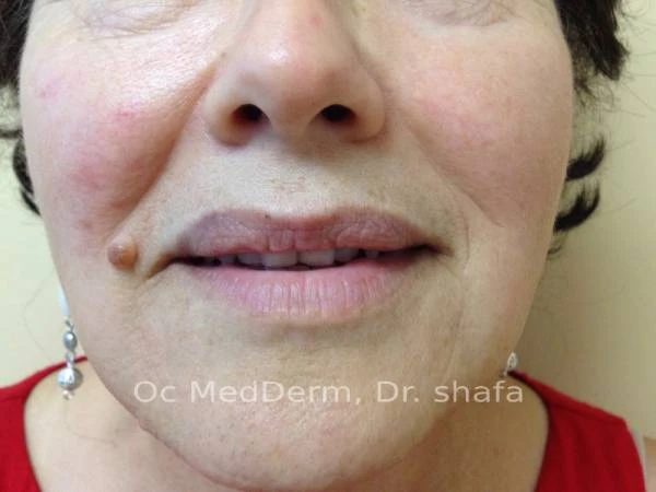 Mole on Cheek Before Mole Removal Treatment in Irvine, CA