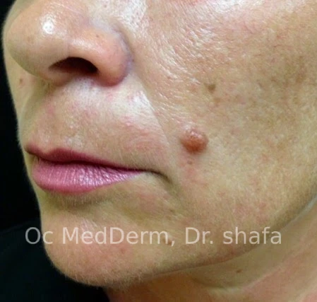 Mole on Cheek Before Mole Removal in Irvine, CA