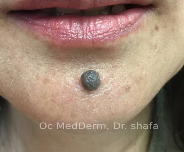 Mole on Chin Before Mole Removal Treatment in Irvine, CA