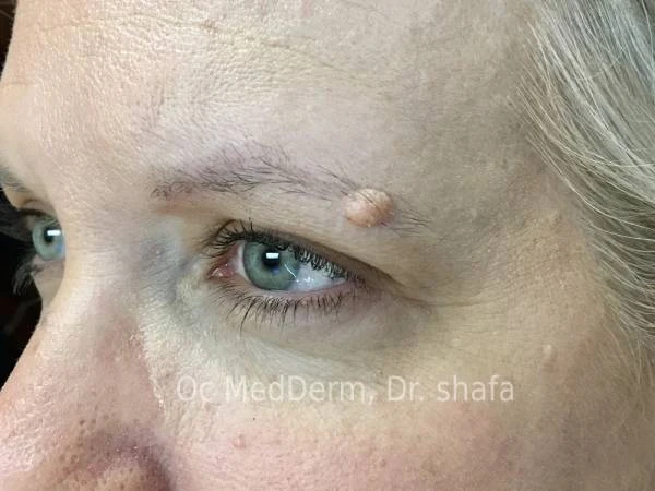 Mole on Eyebrow Before Mole Removal Treatment In Irvine, CA