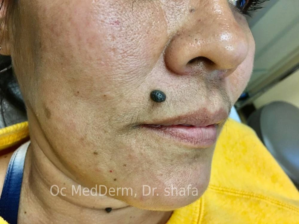 Mole on Face Before Mole Removal in Irvine, CA
