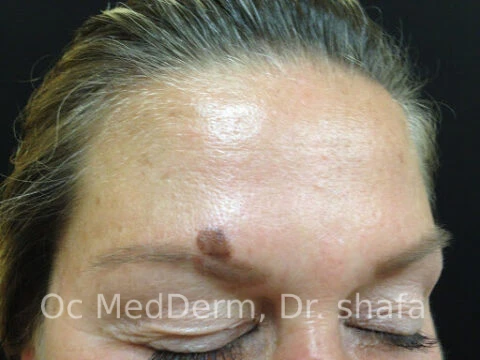 Mole on Forehead Before Mole Removal in Irvine, CA