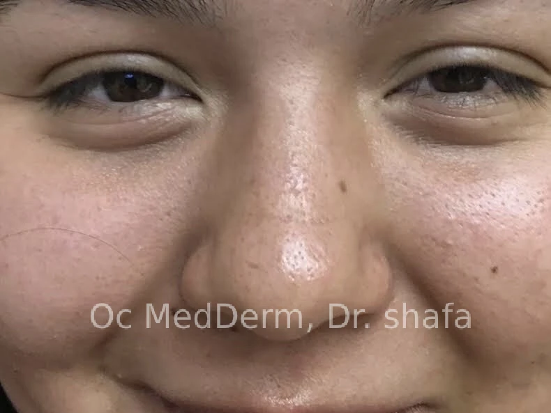 Mole on Nose After Mole Removal Treatment In Irvine, CA