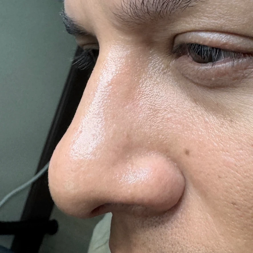 Mole on Nose After Mole Removal Treatment In Irvine, CA