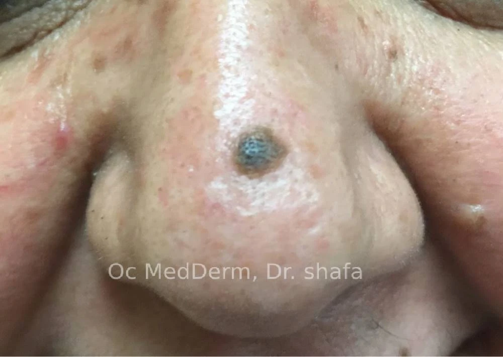 Mole on Nose Before Mole Removal In Irvine, CA