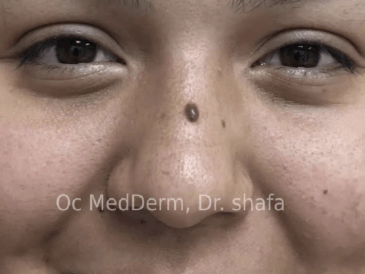 Mole on Nose Before Mole Removal Treatment In Irvine, CA