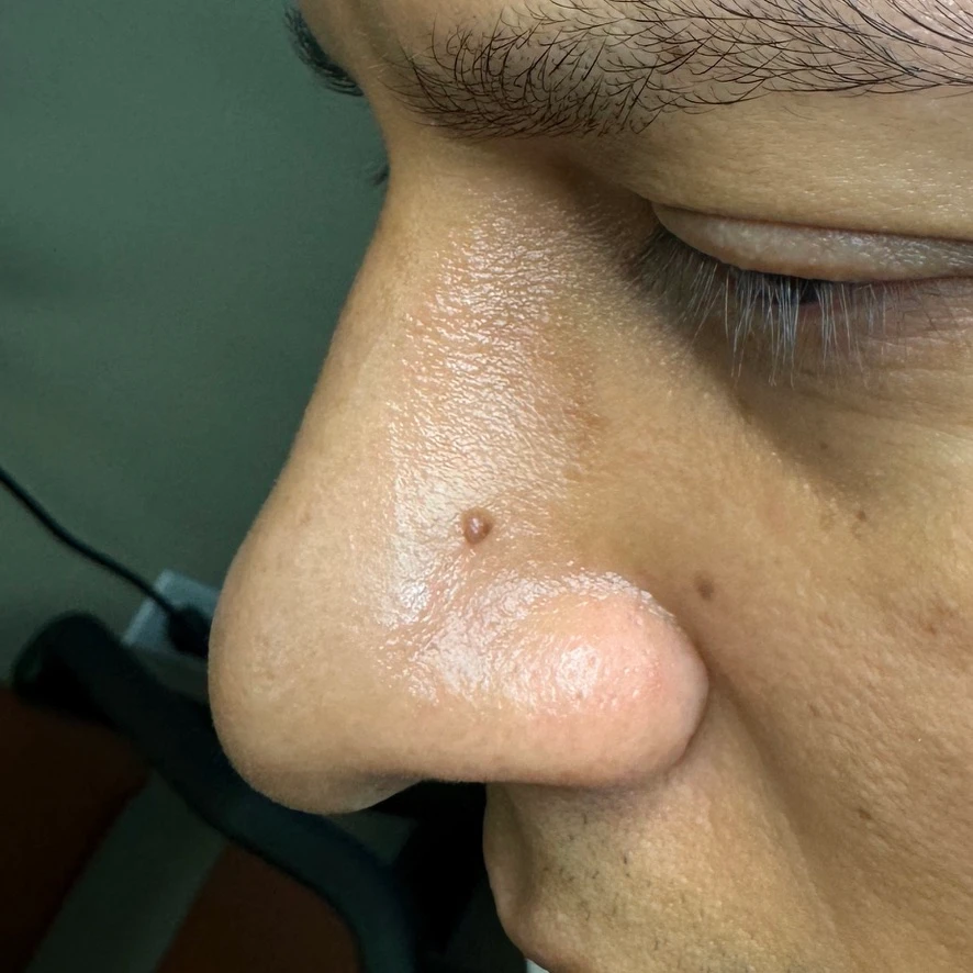 Mole on Nose Before Mole Removal Treatment In Irvine, CA