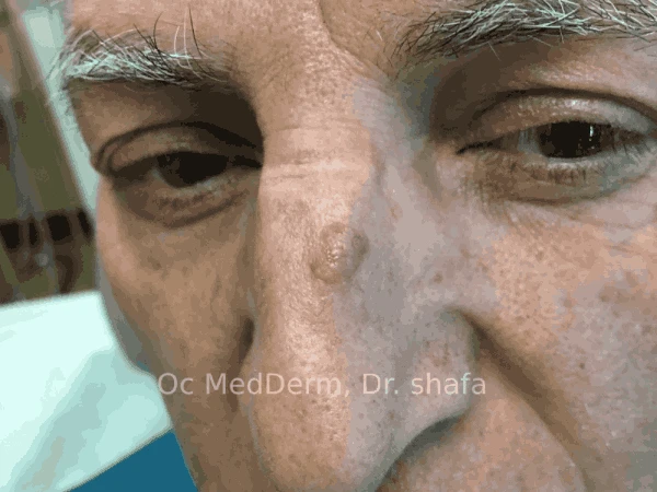 Mole on Nose Before Mole Removal Treatment at OC MedDerm