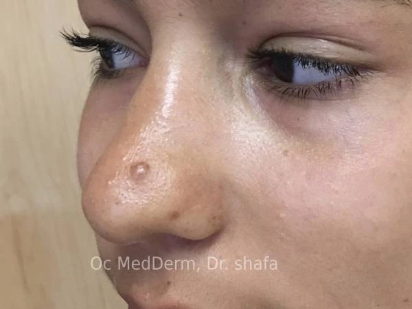 Mole on Nose Before Mole Removal at OC MedDerm