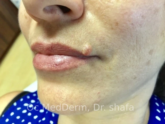 Mole on Upperlip Before Mole Removal Treament in Irvine, CA
