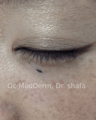 Mole under Eye Before Mole Removal In Irvine, CA