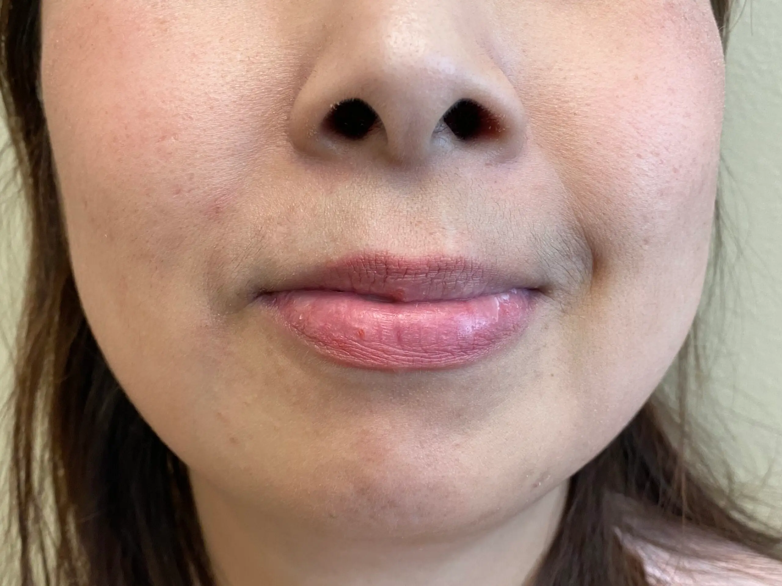 Mole under Nose After Mole Removal In Irvine CA at OC MedDerm
