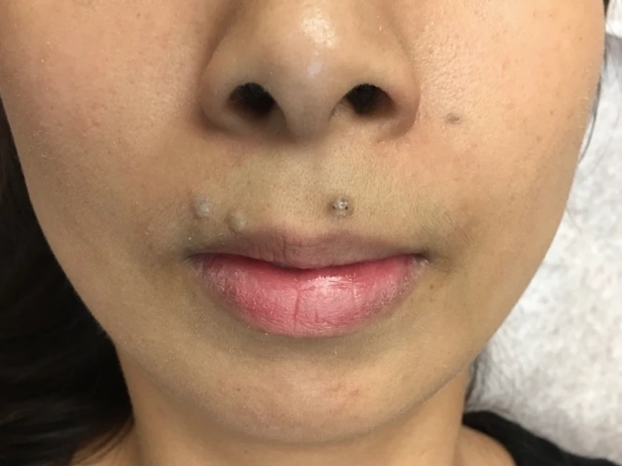 Mole under Nose Before Mole Removal In Irvine CA at OC MedDerm