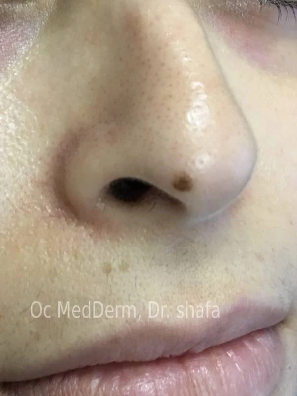 Mole under Nose Before Mole Removal Treatment in Irvine, CA