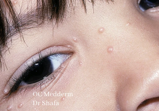 Molluscum contagiosum Irvine Skin
