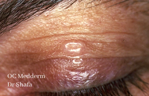 Molluscum contagiosum OC MedDerm Dermatology