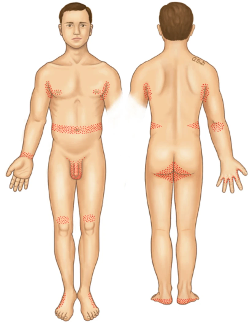 Part of body affected with scabies