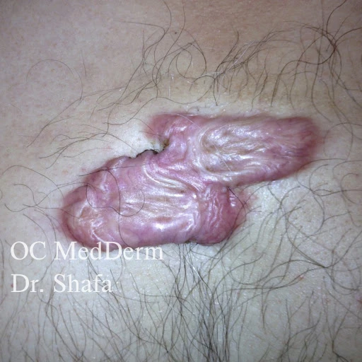 figure-img img-fluid rounded h-300 What is a keloid? Irvine, CA