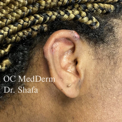 after keloids treatment Irvine CA