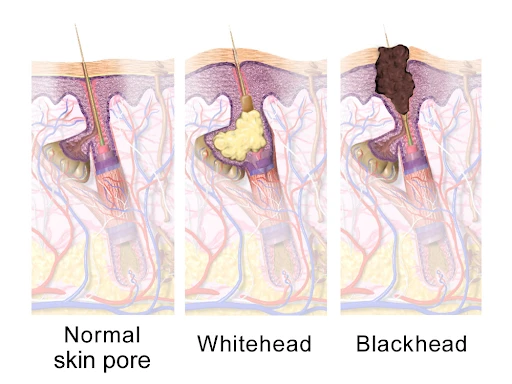 Types of acne irvine, CA