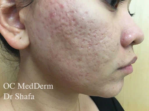 After Fractional CO2 Laser Treatment in Irvine, CA