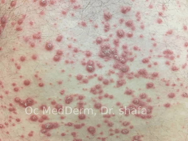 After Chest Psoriasis Treatment in Irvine, CA at OC MedDerm