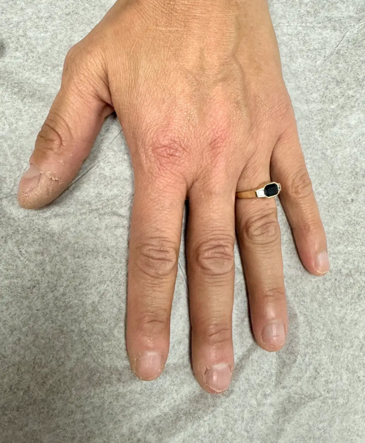 Improved nail psoriasis after treatment at OC MedDerm Irvine, CA