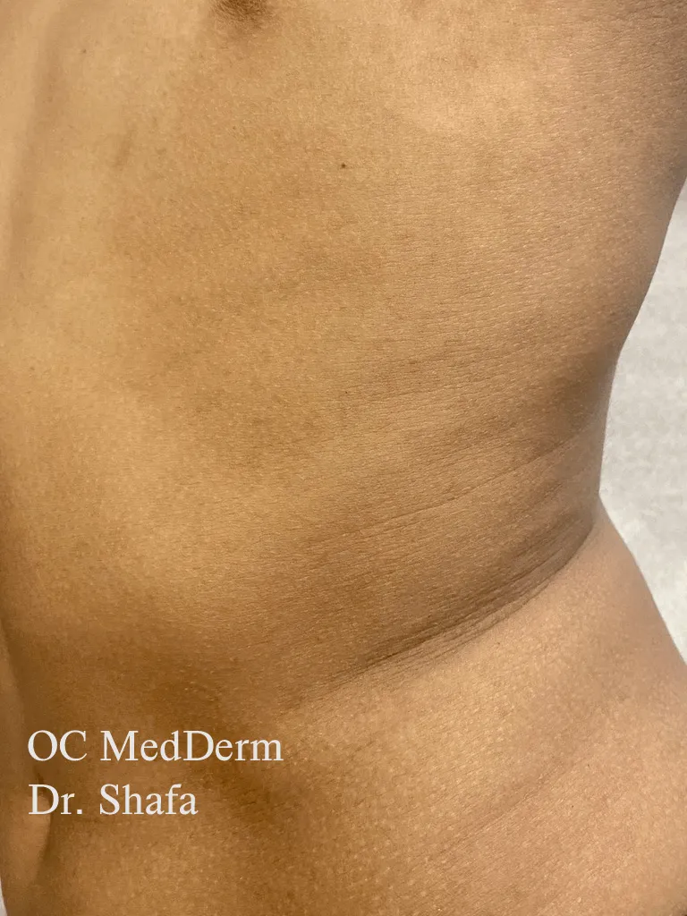 After Psoriasis treatment Irvine, CA