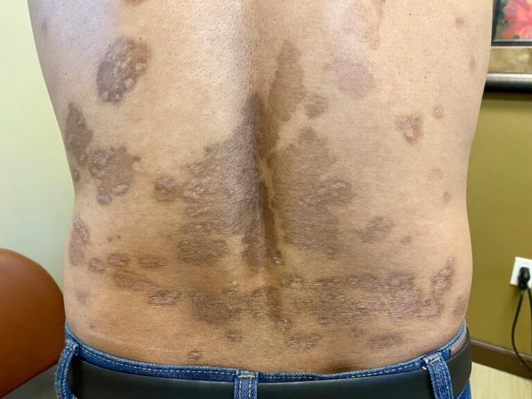 Psoriasis after treatment on lower back at OC MedDerm Irvine and Orange County, CA.