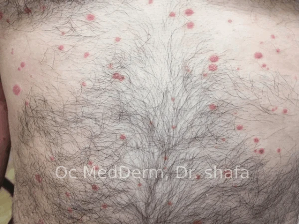 Before Chest Psoriasis Treatment in Irvine, CA at OC MedDerm