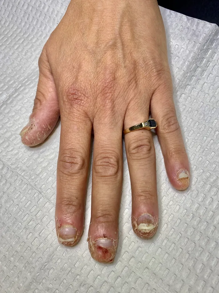 Severe nail psoriasis before treatment at OC MedDerm Irvine, CA