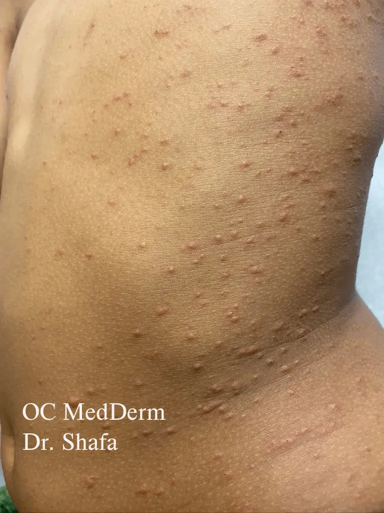 Before Psoriasis-treatment irvine, CA