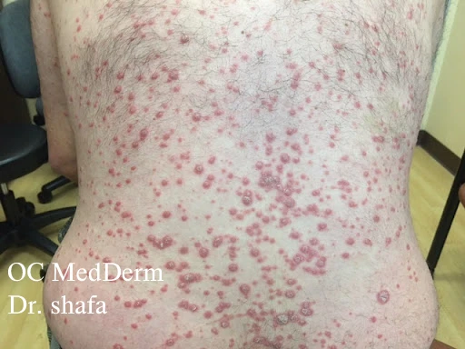 Guttate psoriasis treatment at Irvine, CA | OC MedDerm