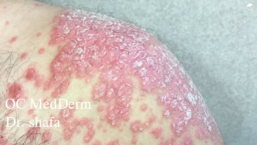 Plaque psoriasis Treatment Irvine, CA
